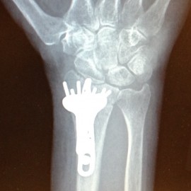 My Distal Radius Fracture and Subsequent Repair