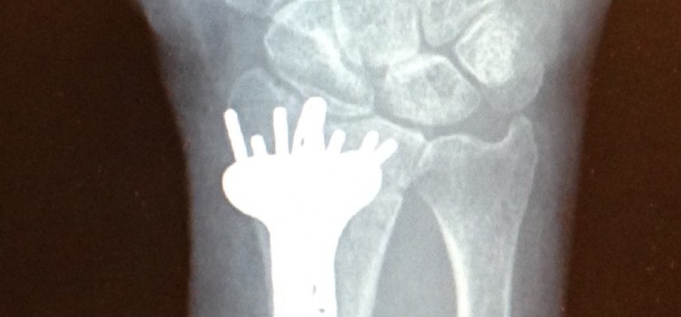 My Distal Radius Fracture and Subsequent Repair